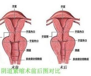 韩妃无痕阴道紧缩术